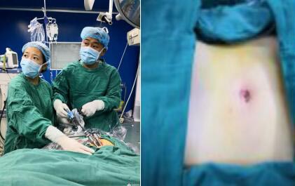 单孔腹腔镜手术